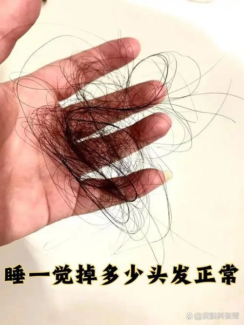 做梦梦见掉头发成光头-梦秃