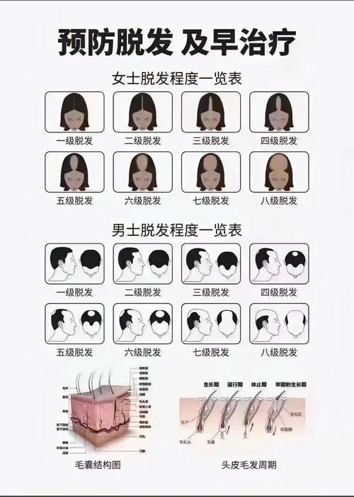 什么是dht脱发_1