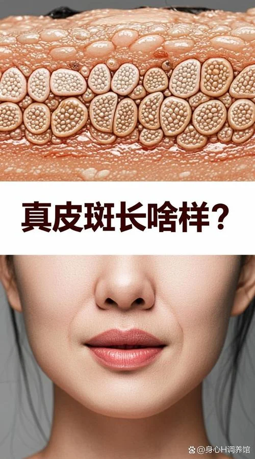 脸上圆形斑叫什么斑_1