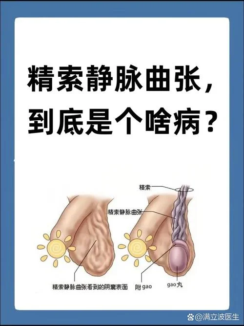 如何查精索静脉曲张_1
