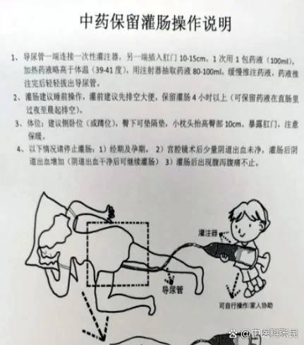 什么是高位灌肠_1