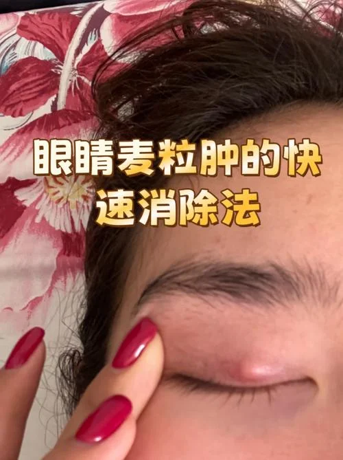 熬夜眼袋肿了怎么办_1