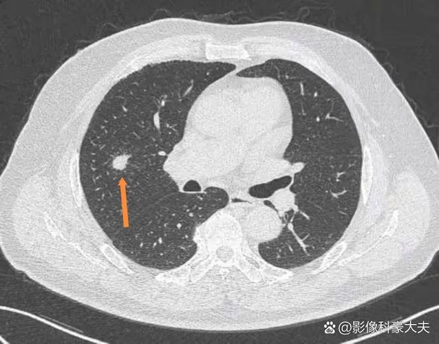 肺结节分叶是什么意思_1