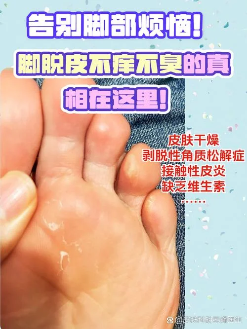 脚痒起泡脱皮怎么办-脚痒起泡脱皮怎么办