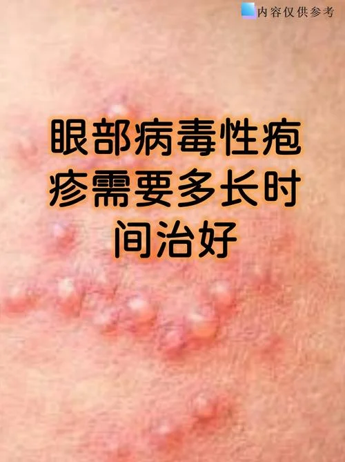 有病毒性疱疹怎么办-病毒性疱疹怎么办