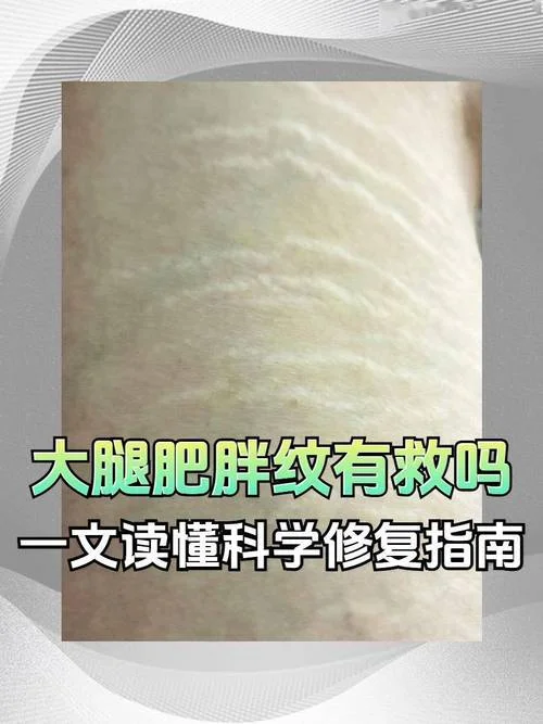 长胖的纹路叫什么-长胖纹路名