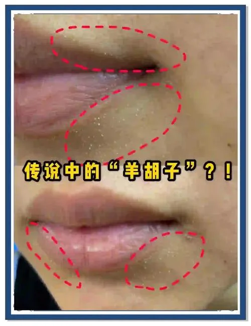 女生长胡子怎么办-女生长胡子怎么办