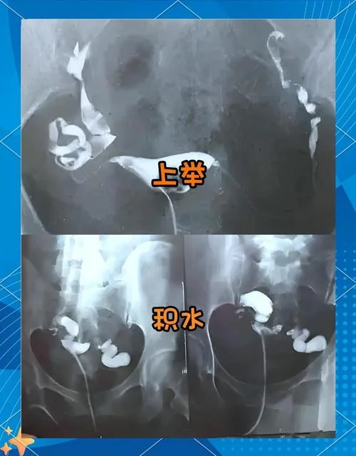 四川省省医院做输卵管造影是用的什么造影剂_1
