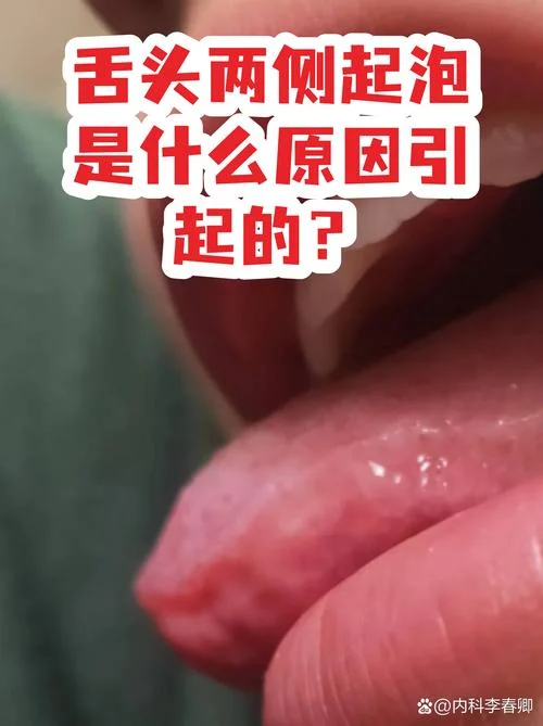 舌头被烫起泡了怎么办_1