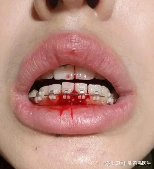 梦见牙龈出血块是什么_1