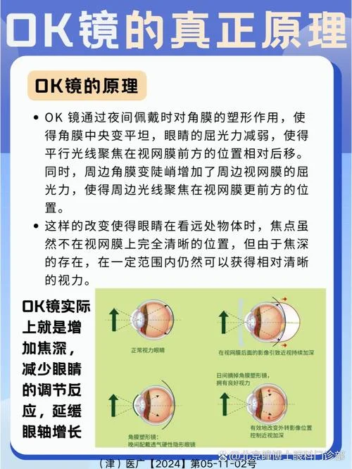 角膜镜原理_2