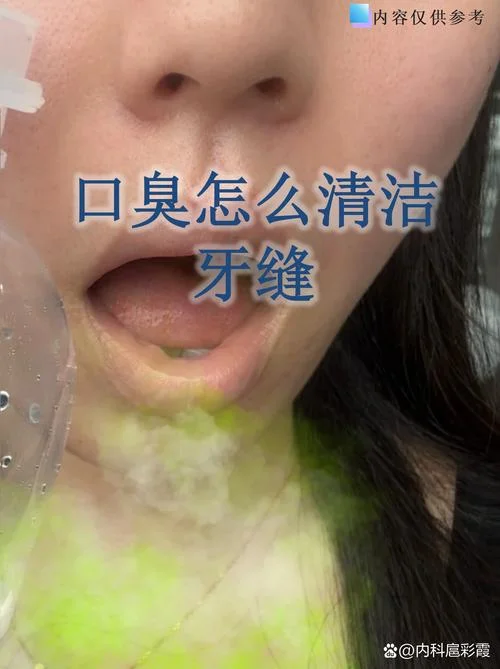 牙齿内壁有黑垢怎么办-去除牙齿内壁黑垢