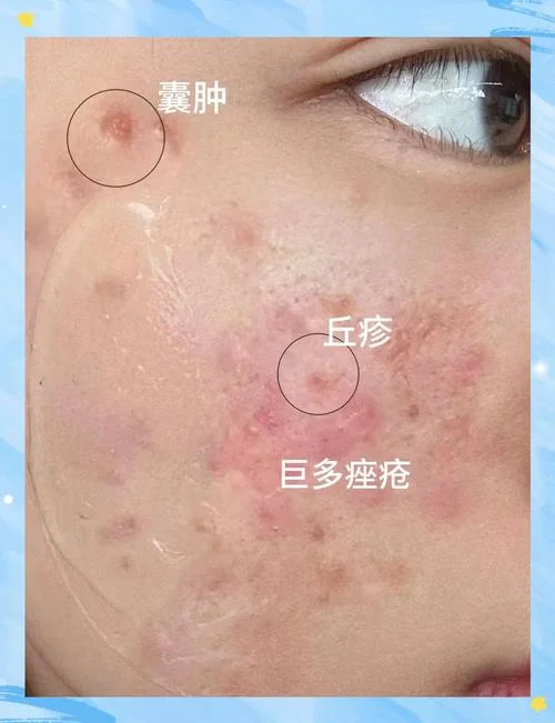 痤疮是有什么引起的_1