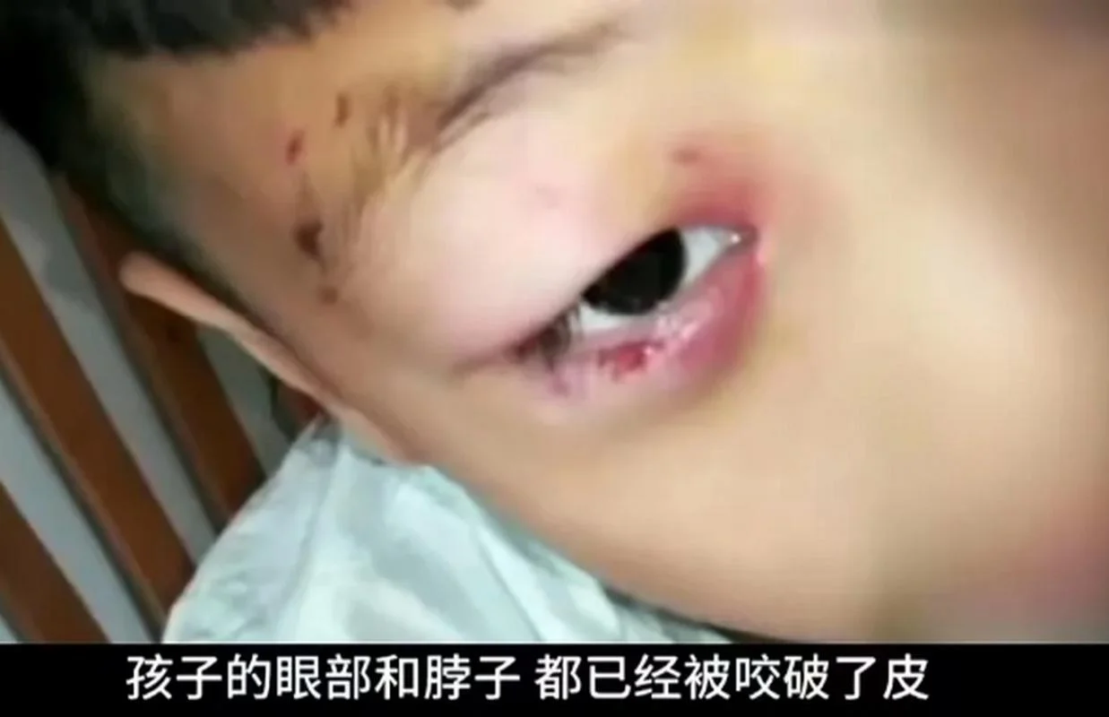 梦见被小男孩咬了一口-梦被男孩咬了一口