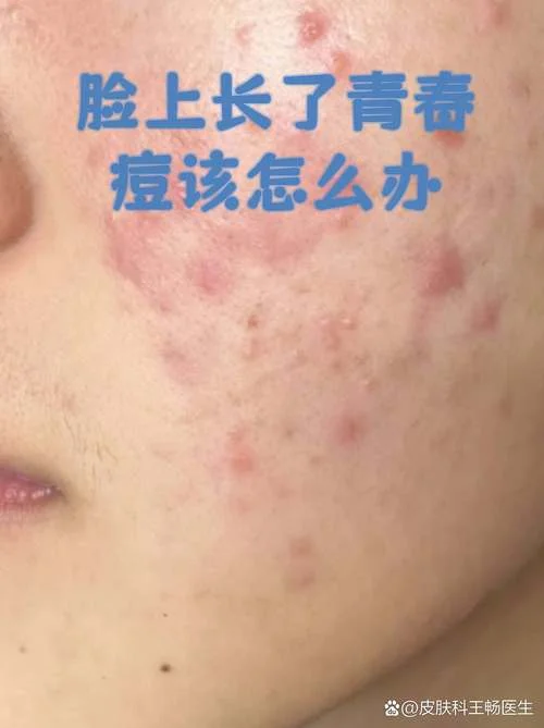 脸上快要长痘痘怎么办-痘痘难消怎么办