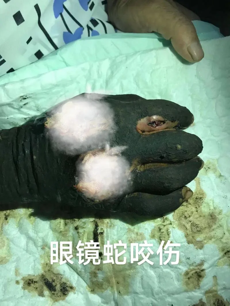 孕妇梦到被蛇咬了手-孕妇被蛇咬手梦