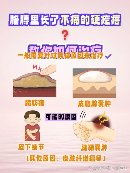 脂肪填充硬块怎么办-脂肪填充后硬块