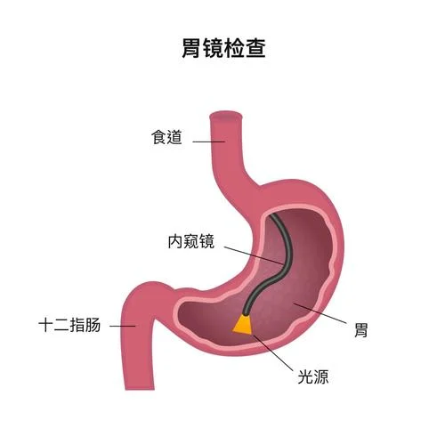 胃镜如何查幽门螺杆菌_1