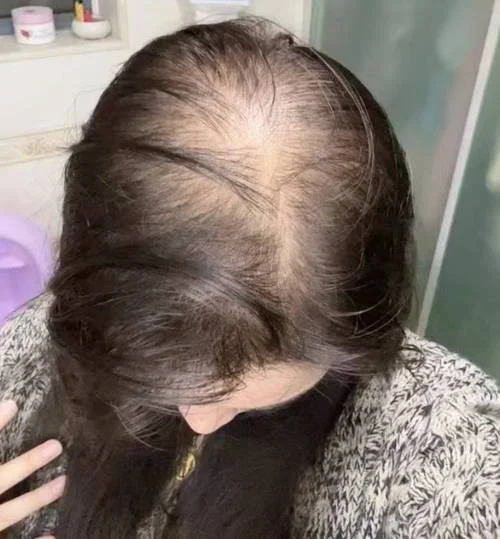 是秃顶梦见长头发了_2