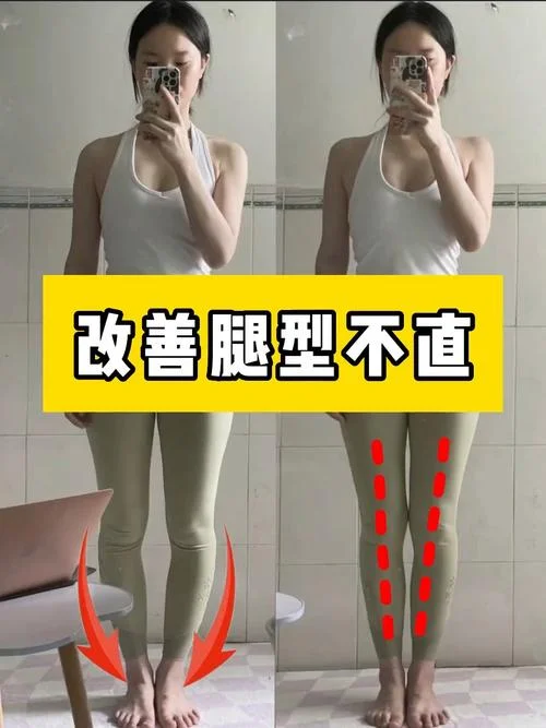o型腿太严重怎么办-严重 O 型腿怎么办