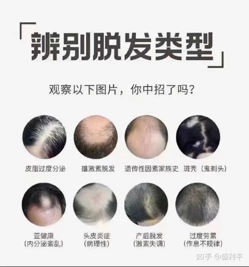 掉头发是缺什么东西吗_1