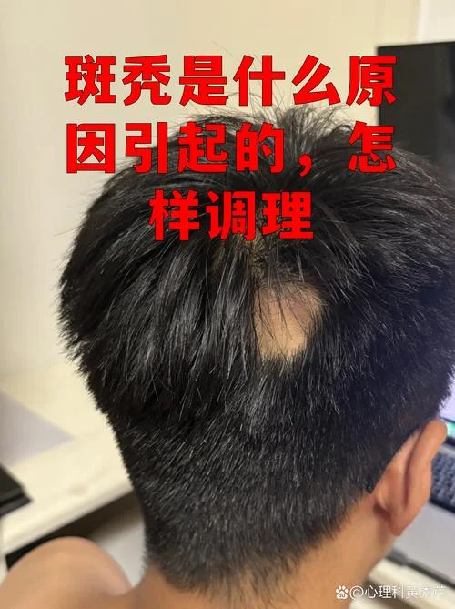 什么是男性脱发信息_1