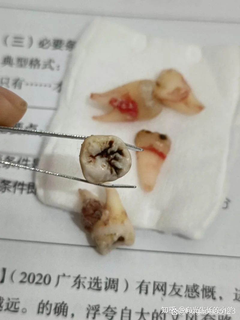 拔牙的感言和感悟_2