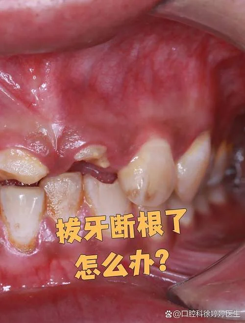 梦到拔牙拔错了-梦错拔牙