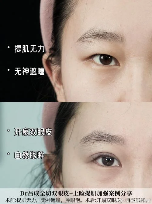 微整形项目开眼角_1