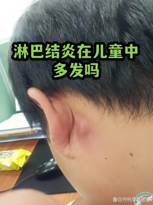 小孩得了淋巴炎怎么办_2