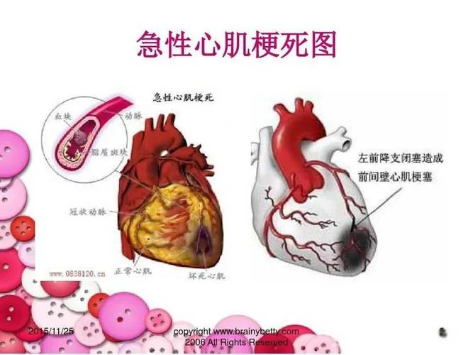 什么是原发性心肌病_1