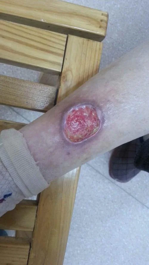 梦见自己摔倒了腿烂了-梦见摔腿烂。