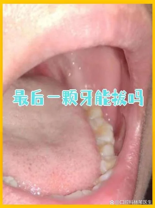 最后一颗牙齿叫什么牙_2