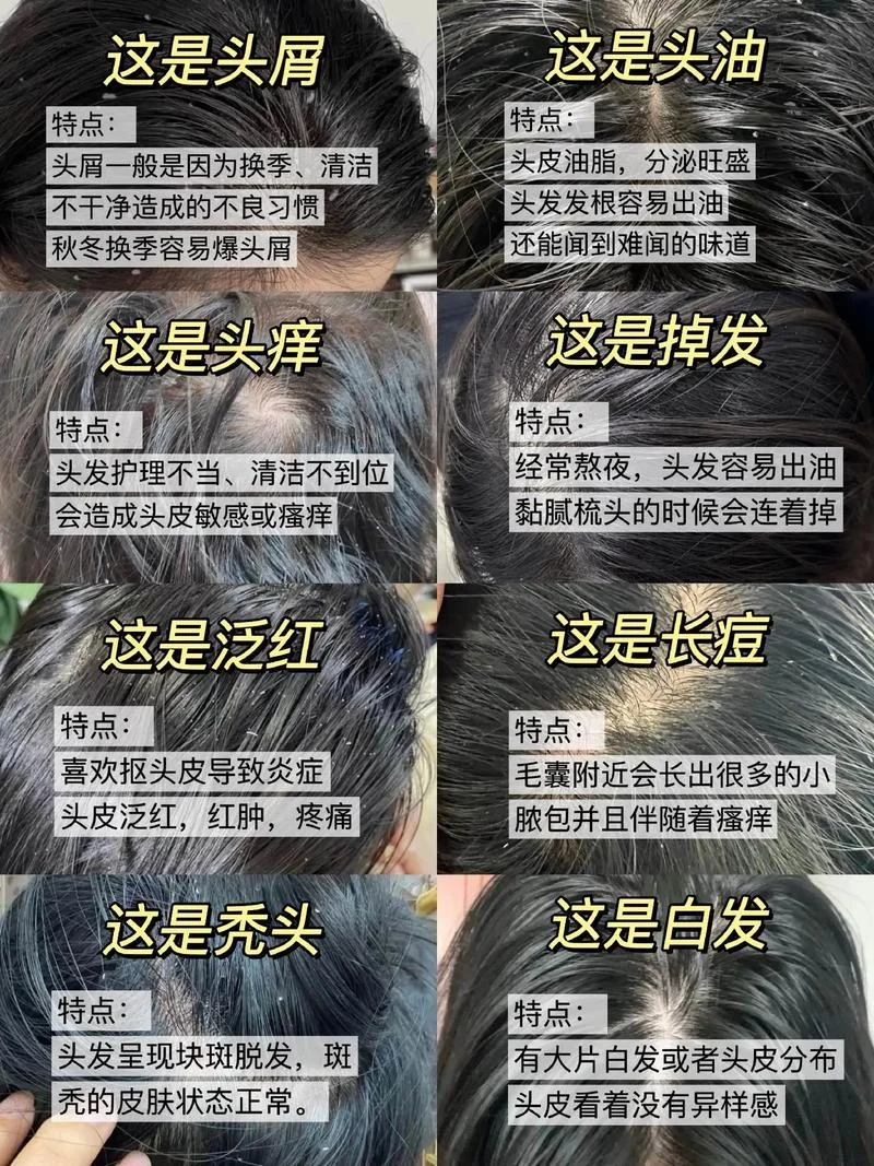 头皮有蜡怎么办_1