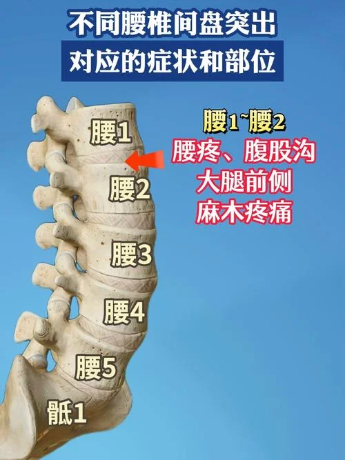 腰椎病变是指什么_1
