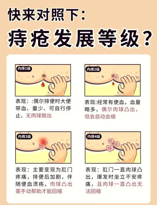 内痔脱出自愈经历_1