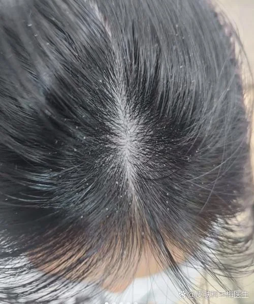 梦见头上掉头皮屑是什么意思-梦见掉头皮屑寓意