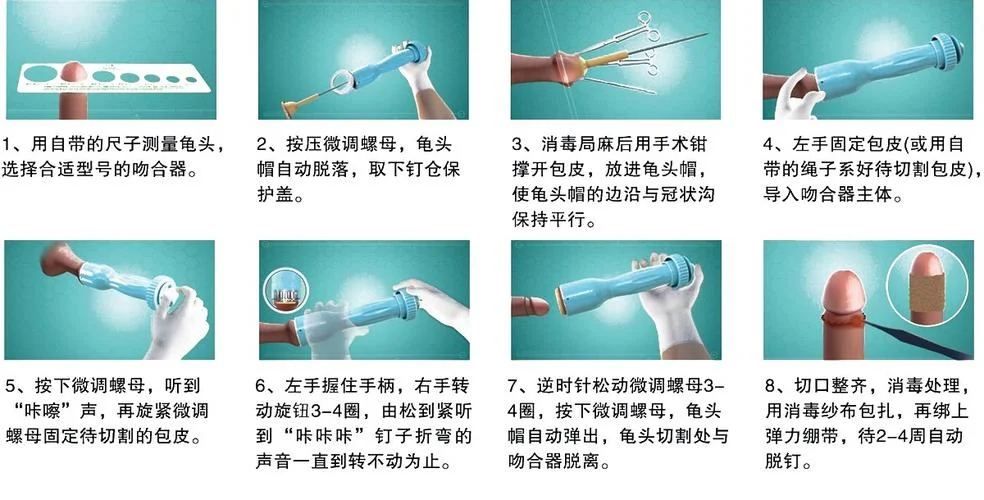 痔疮套扎吻合器怎么用_2