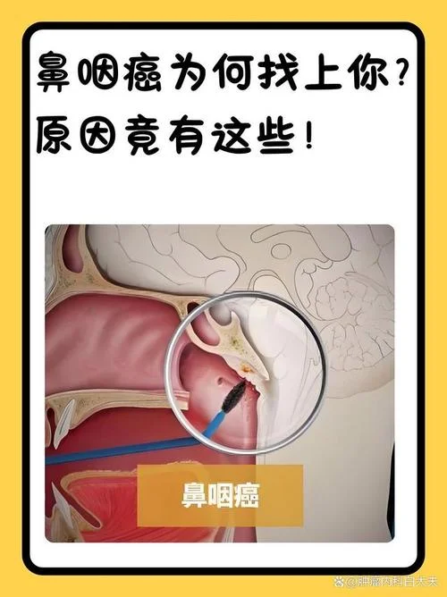 什么是淋巴癌鼻癌_1