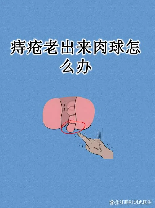 痔核脱出自己割_2