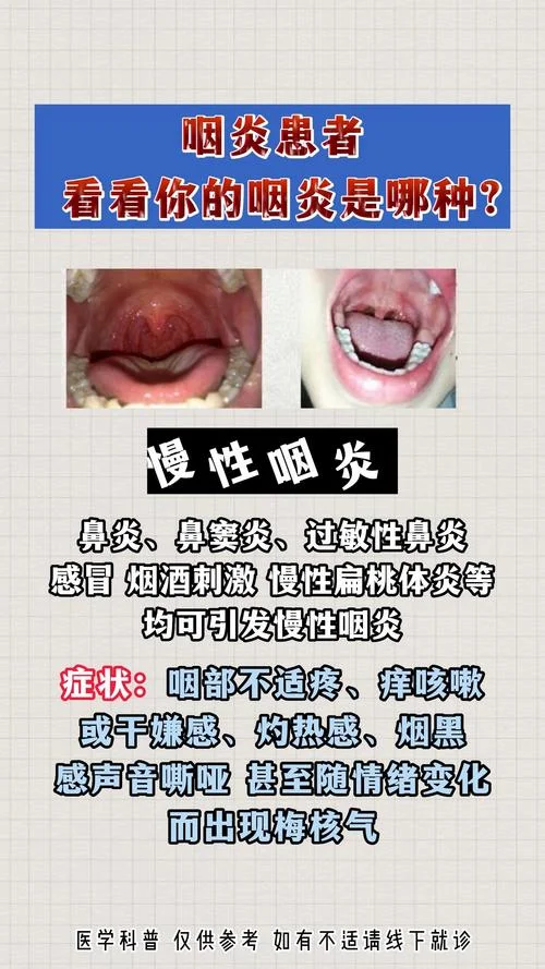 什么是病毒性咽炎_2
