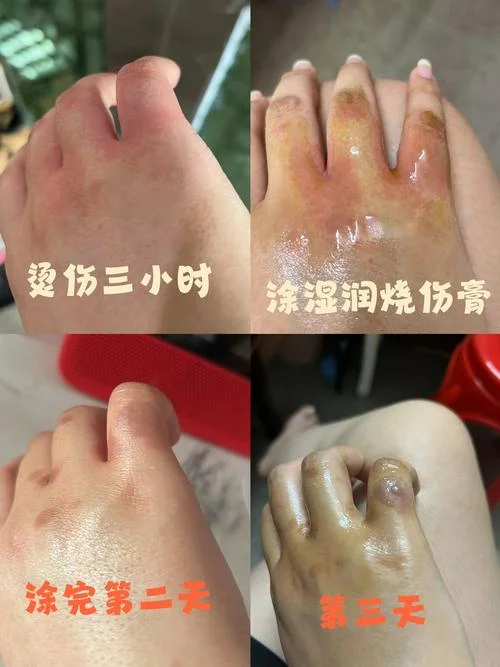 烧伤烫膏哪个牌子好_1