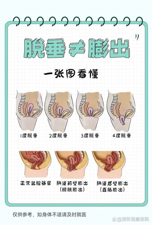 阴壁膨出自检_1