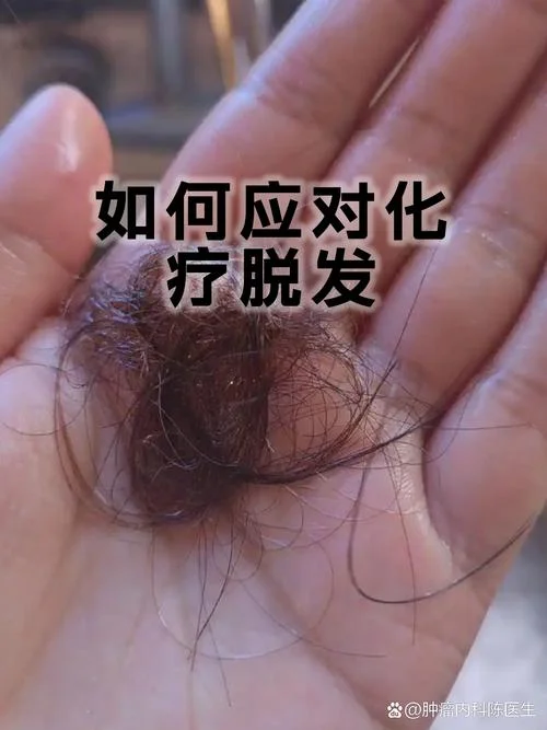 染发油脂性脱发怎么办_2