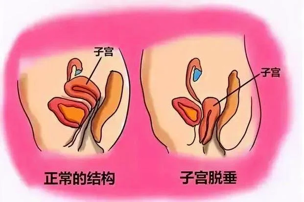什么是t型子宫_2