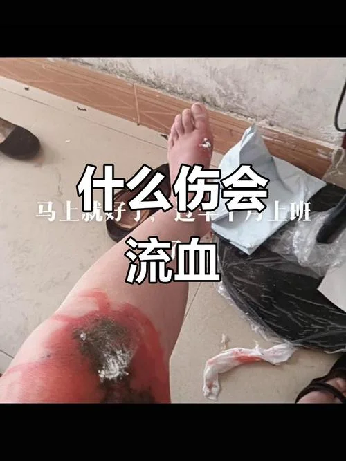 梦见自己受伤流血着呢-梦见受伤流血