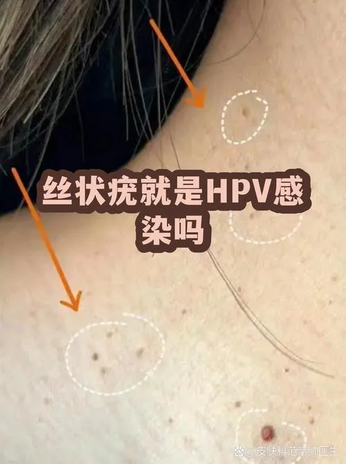 什么是Hpv_1
