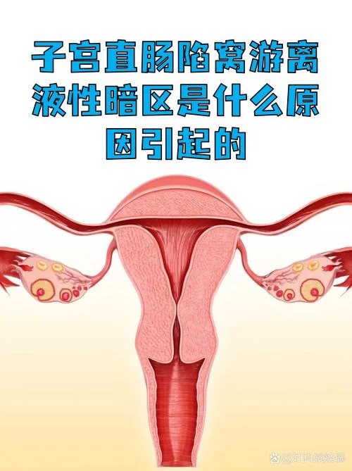 盆腔积液如何查_1