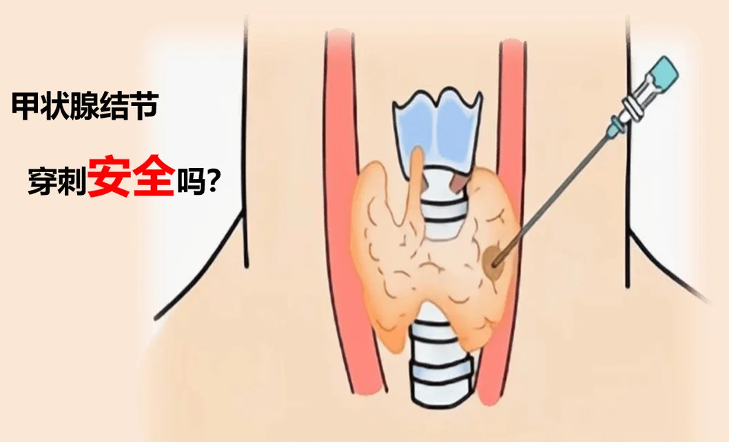 甲状腺穿刺检查叫什么_2