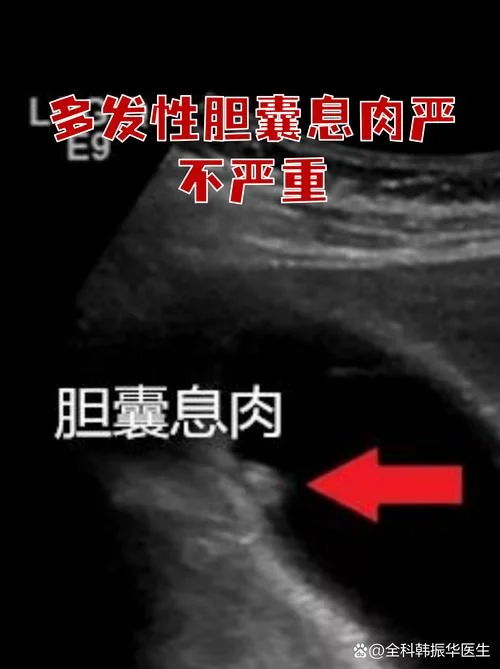 胆囊占位是什么意思_1